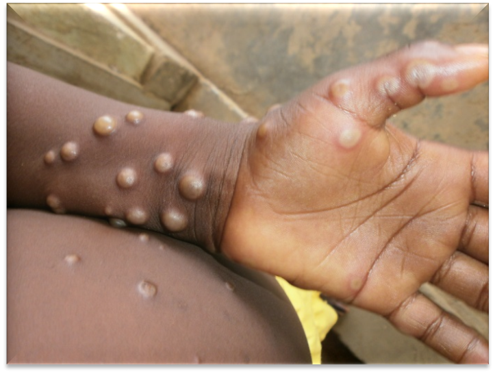 Monkeypox Appearances